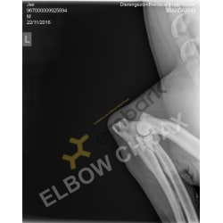 Elbow left
