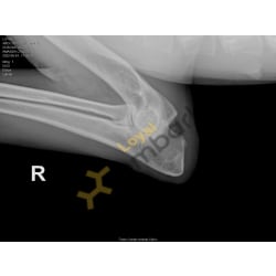 Right Elbow Normal Preliminary X-rays 
